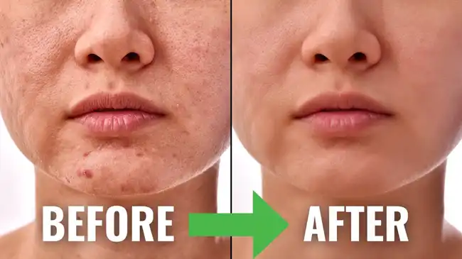 Nicotinamide Nicotinamide