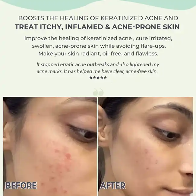 Azelaic Acid for Acne Azelaic Acid for Acne
